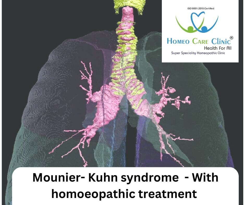 Understanding Mounier-Kuhn Syndrome: Symptoms and Treatment