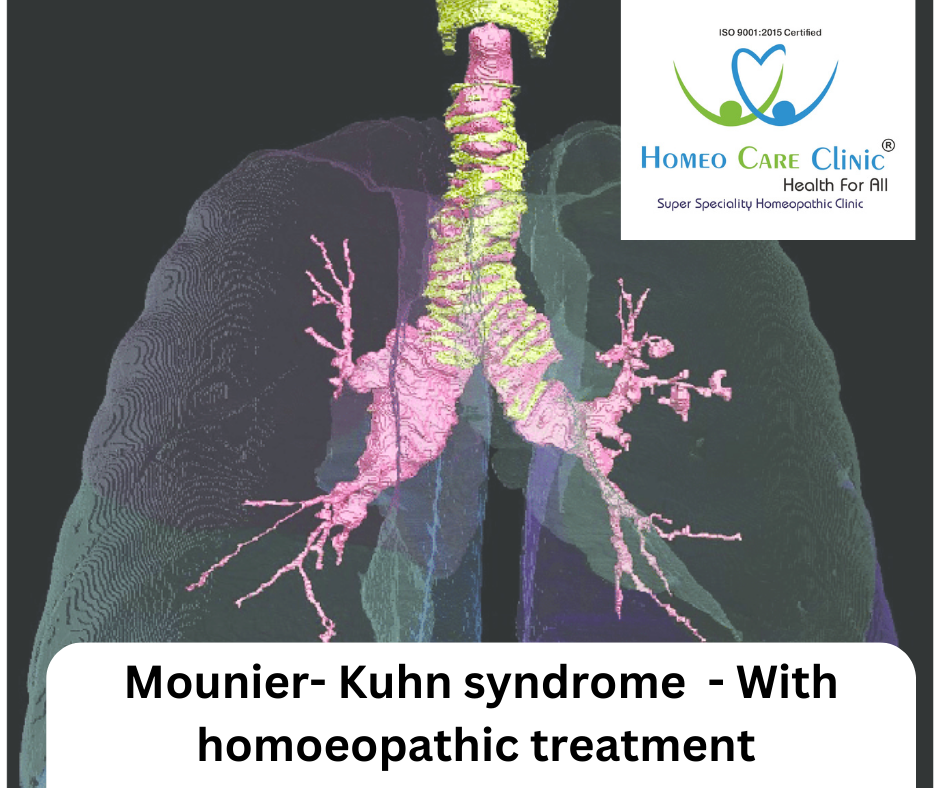 Understanding Mounier-Kuhn Syndrome: Symptoms and Treatment