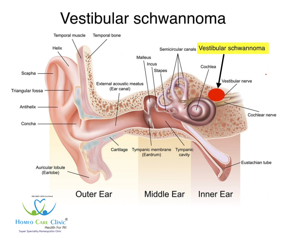 Vestibular Schwannoma treatment with homeopathy for balance and hearing improvement.