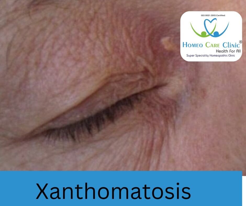 Xanthomatosis skin lesions on legs and arms