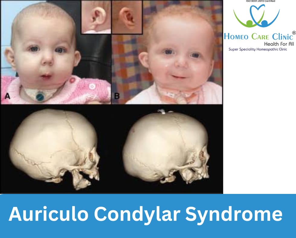 causes of Auriculo-Condylary Syndrome