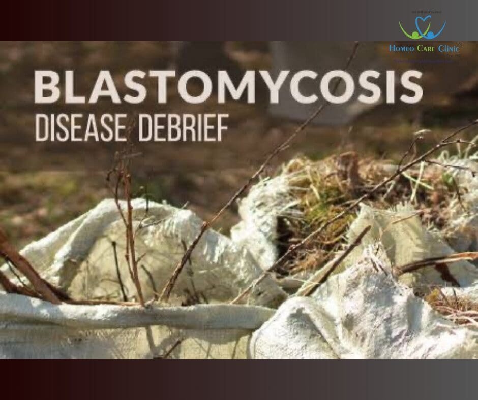 Treating Blastomycosis symptoms with homeopathy