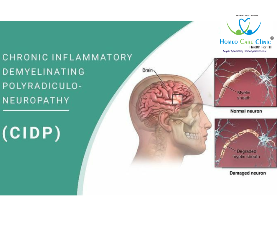 CIDP causes and homeopathic treatment