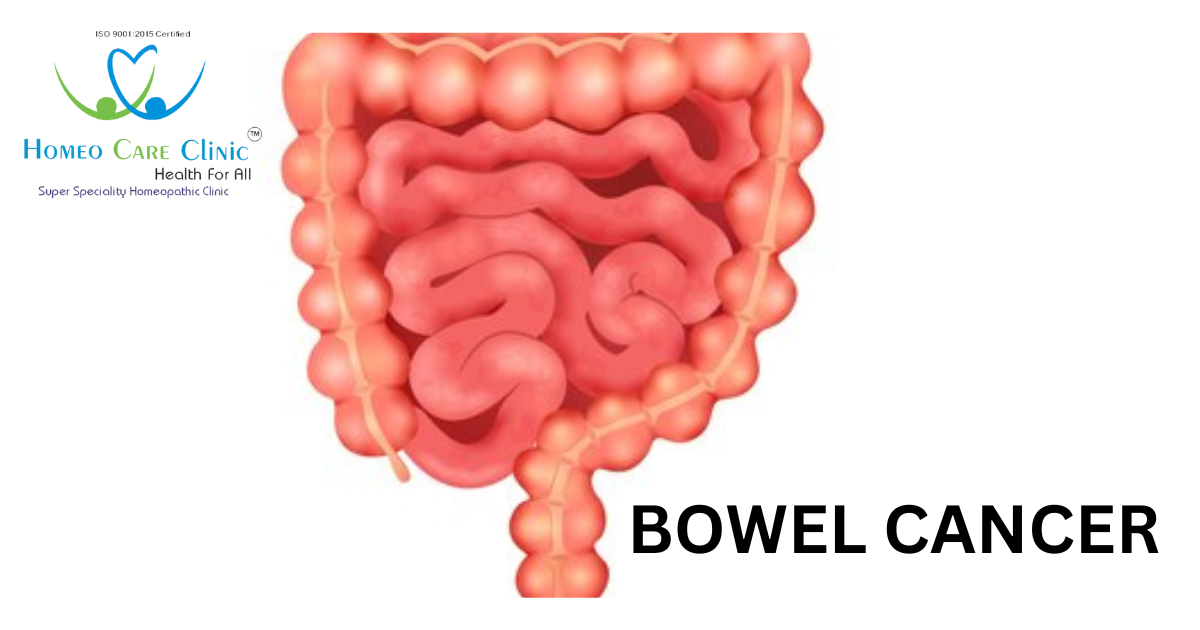 Bowel cancer diagnosis and treatment options