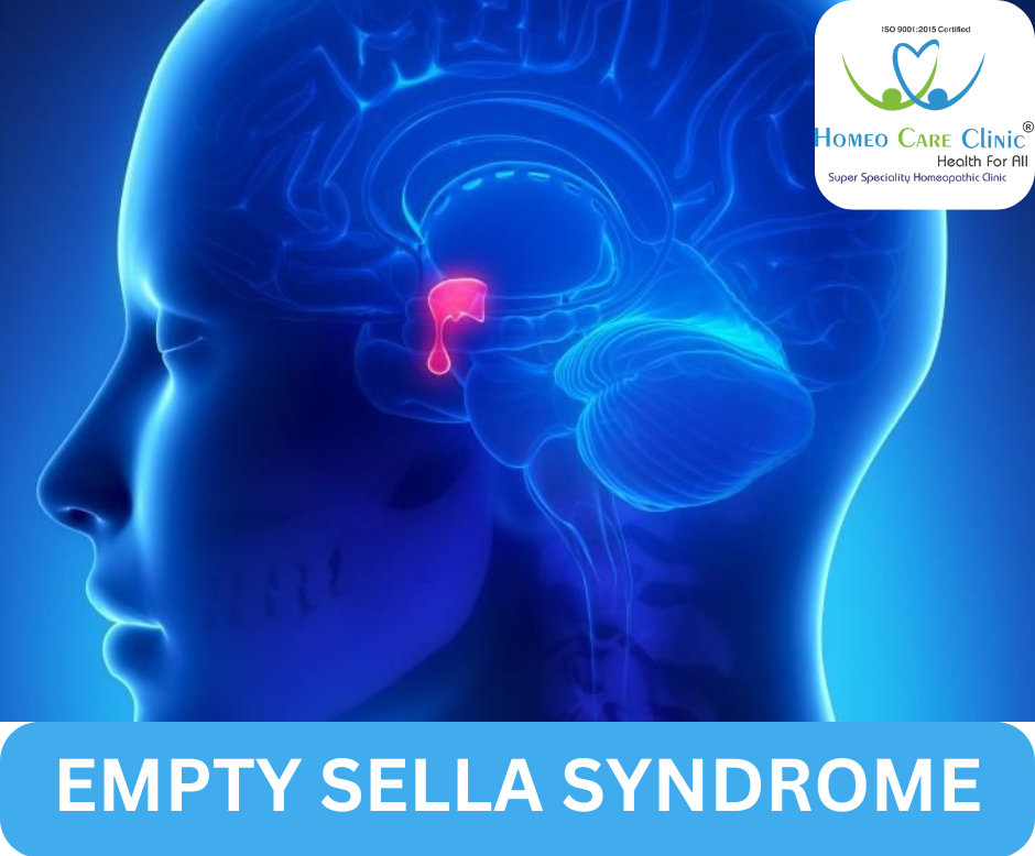 Empty Sella Syndrome causes