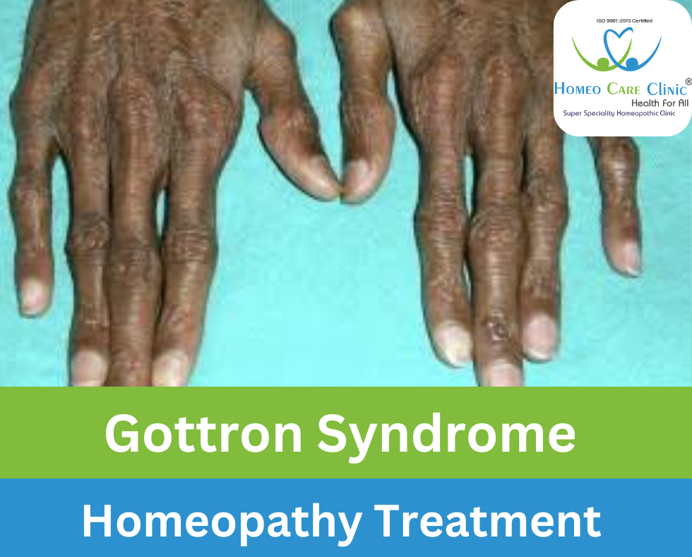 Gottron Syndrome causes & treatment