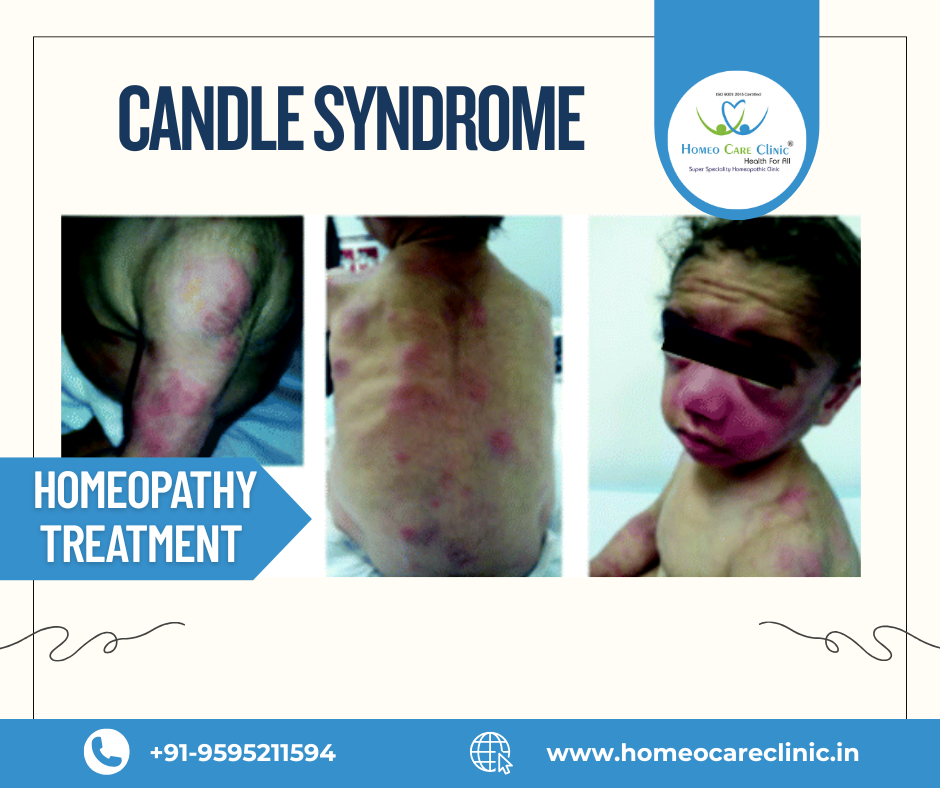 Effective homeopathic solutions for CANDLE Syndrome