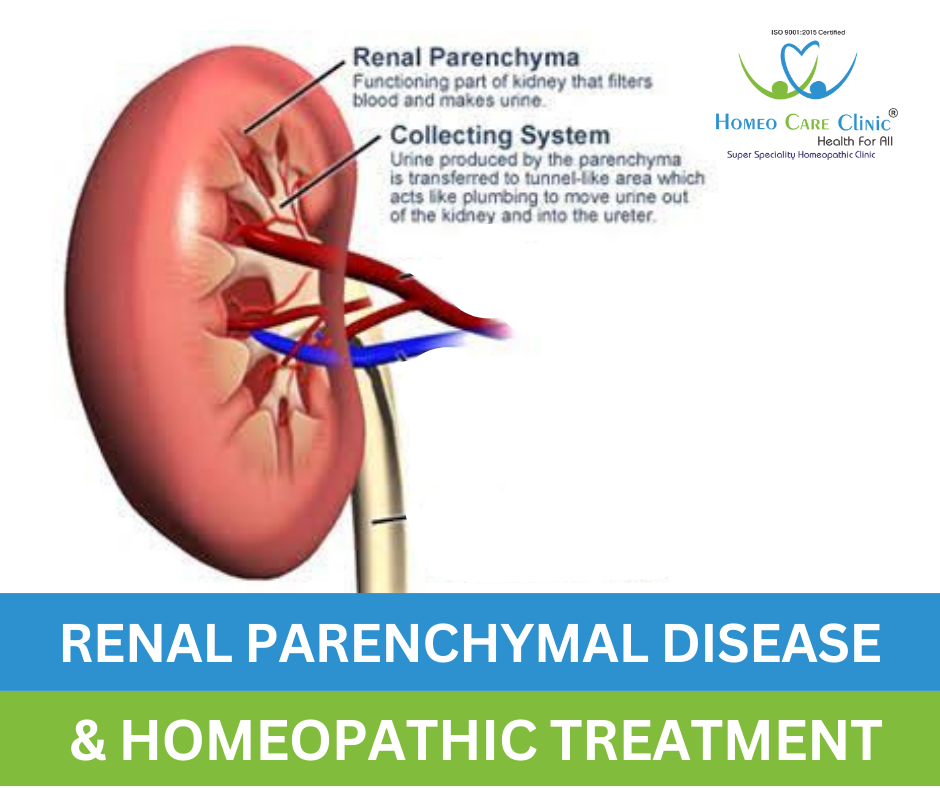 Renal Parenchymal Disease Treatment in Homeopathy​