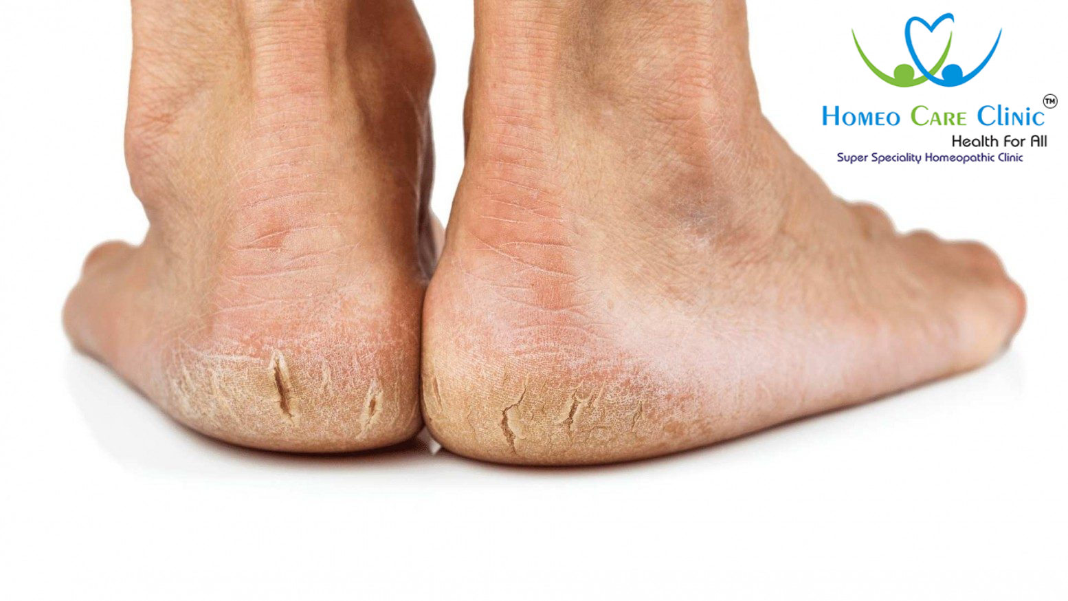 Cracked heel treatment and homeopathic remedie