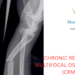 Chronic Recurrent Multifocal Osteomyelitis Bone Disorder