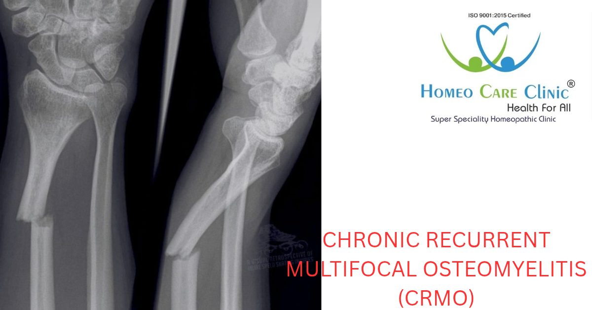 Chronic Recurrent Multifocal Osteomyelitis Bone Disorder