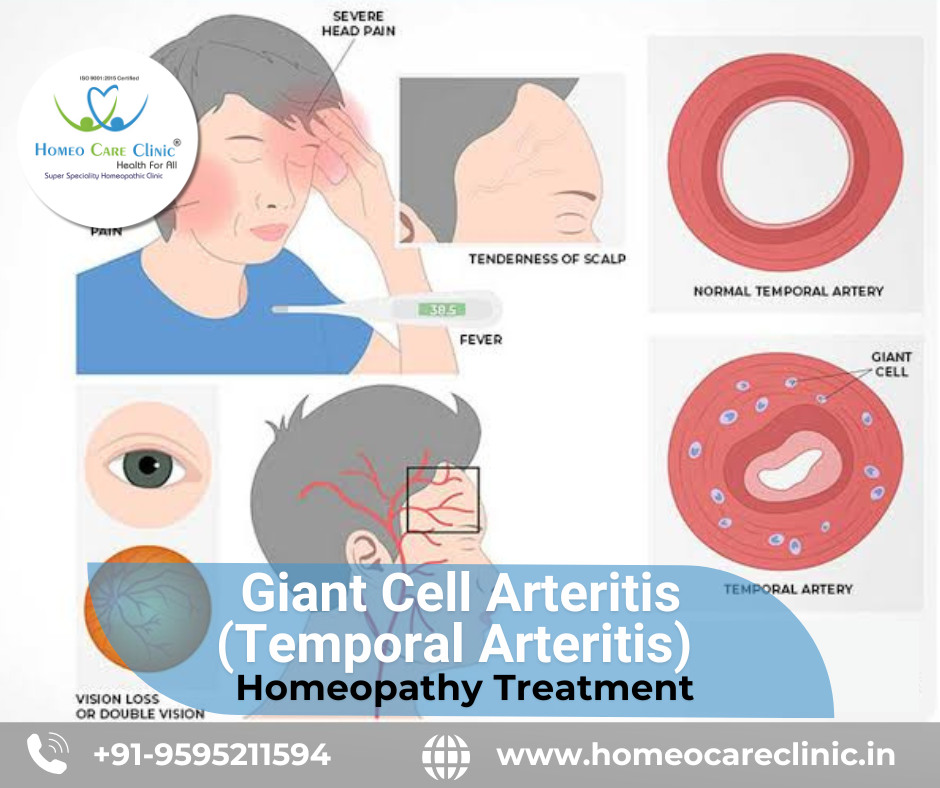 Homeopathic Cure for Giant Cell Arteritis