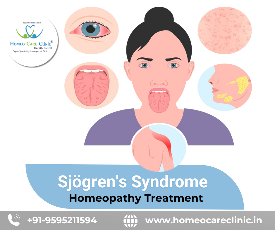 Dry eyes and mouth due to Sjogren’s Syndrome