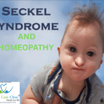 Seckel Syndrome overview