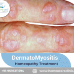 Dermatomyositis treatment with homeopathy