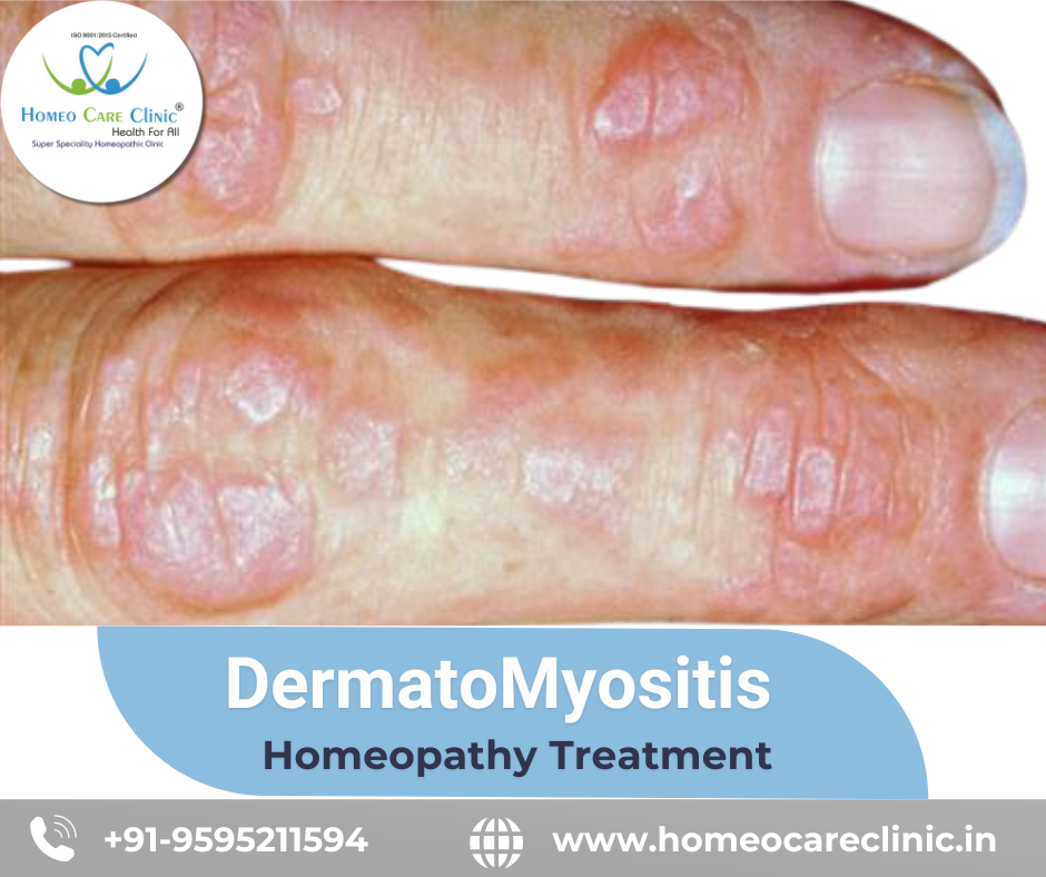 Dermatomyositis treatment with homeopathy