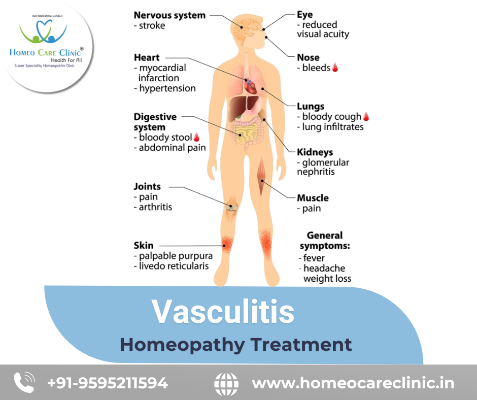Symptoms and causes of vasculitis