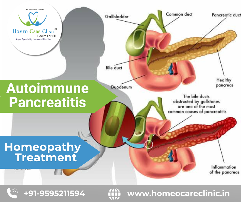Homeopathy for Autoimmune Pancreatitis