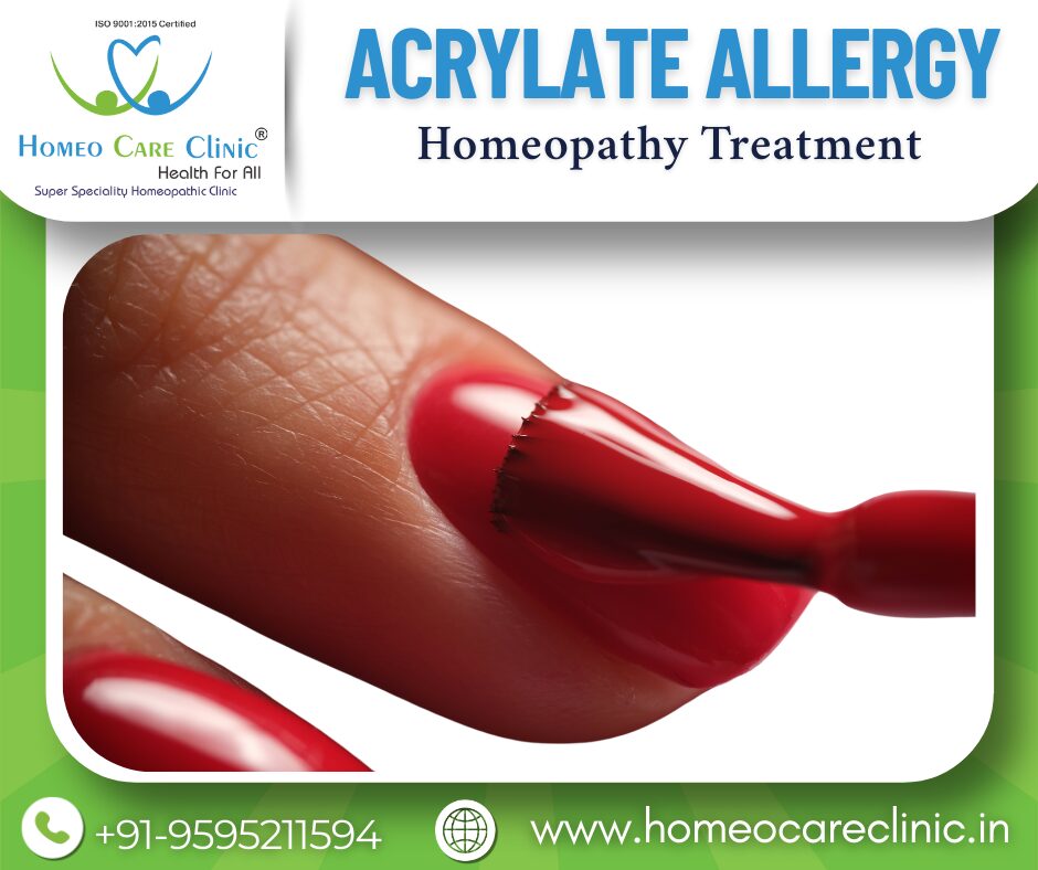 Acrylate Allergy Symptoms & Homeopathic Treatment