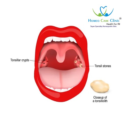 Homeopathic treatment for tonsil stones naturally