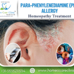 PPD Allergy symtoms