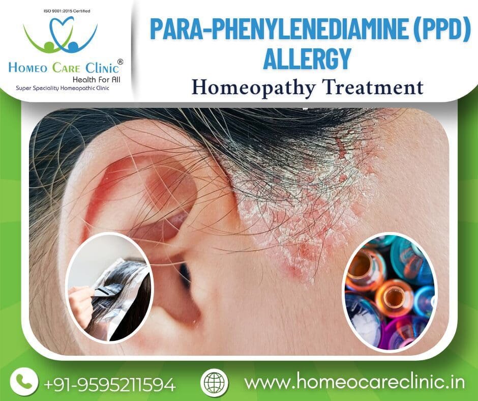 PPD Allergy symtoms