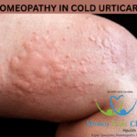 Cold urticaria rash on hand