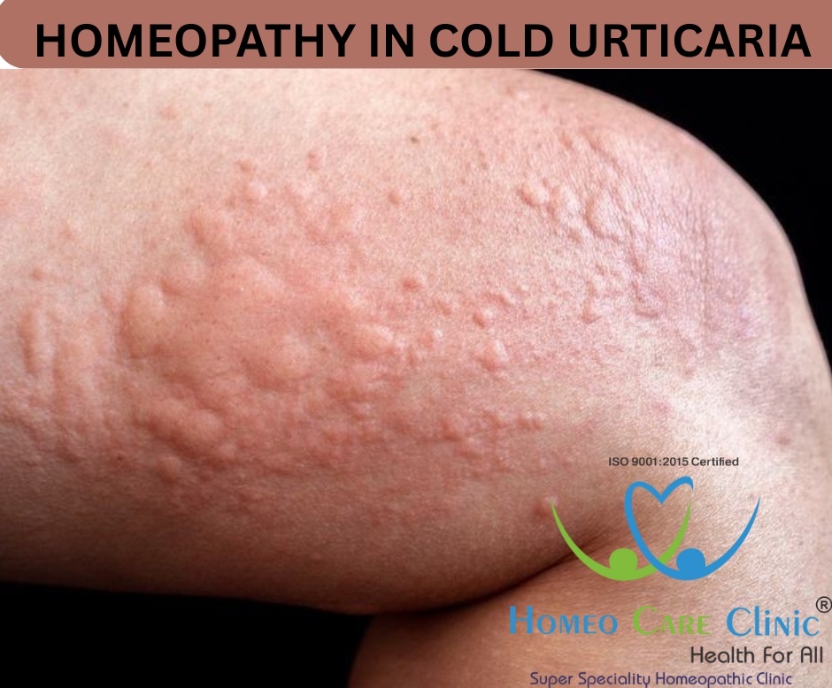 Cold urticaria rash on hand