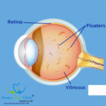 eye floaters in vision