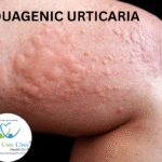 Aquagenic Urticaria