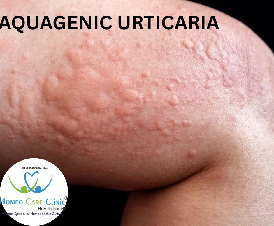 Aquagenic Urticaria