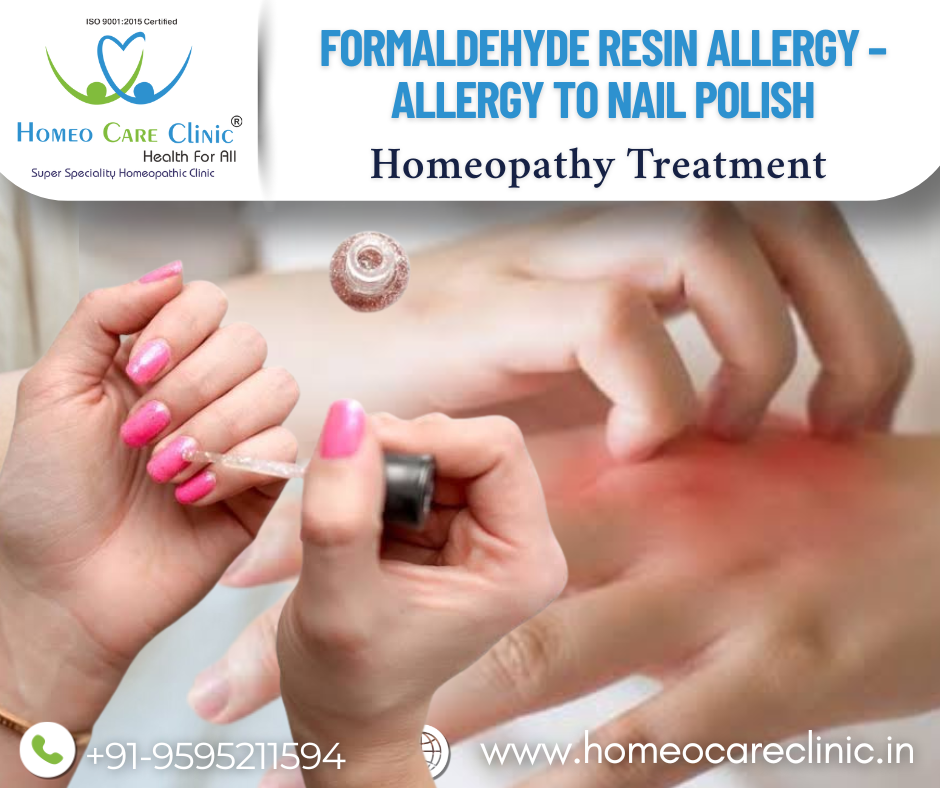 Homeopathic remedies for formaldehyde resin allergy