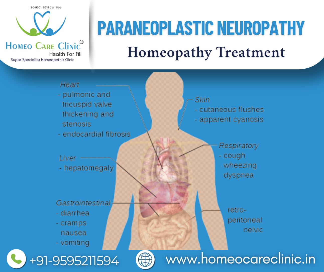Paraneoplastic Neuropathy