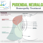 pudendal neuralgia treatment