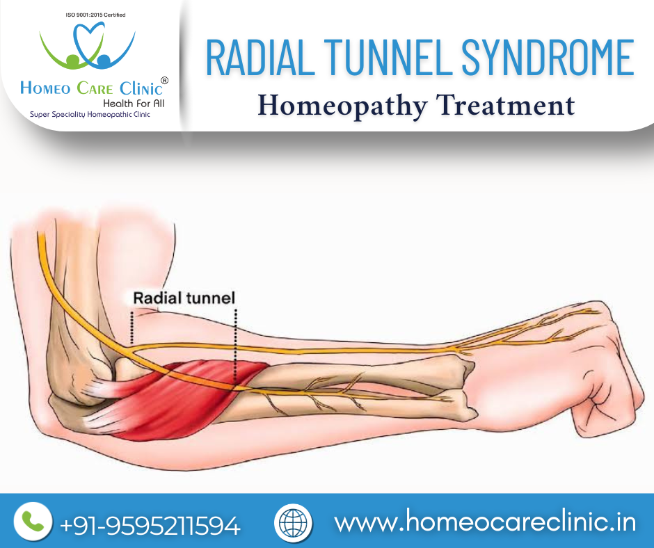 Radial Tunnel Syndrome