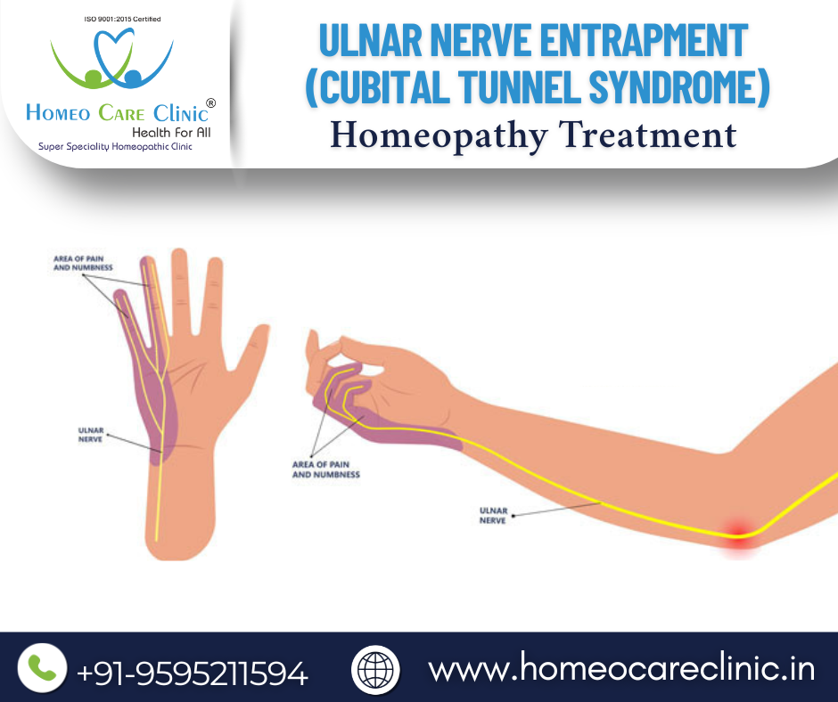 Ulnar Nerve Treatment