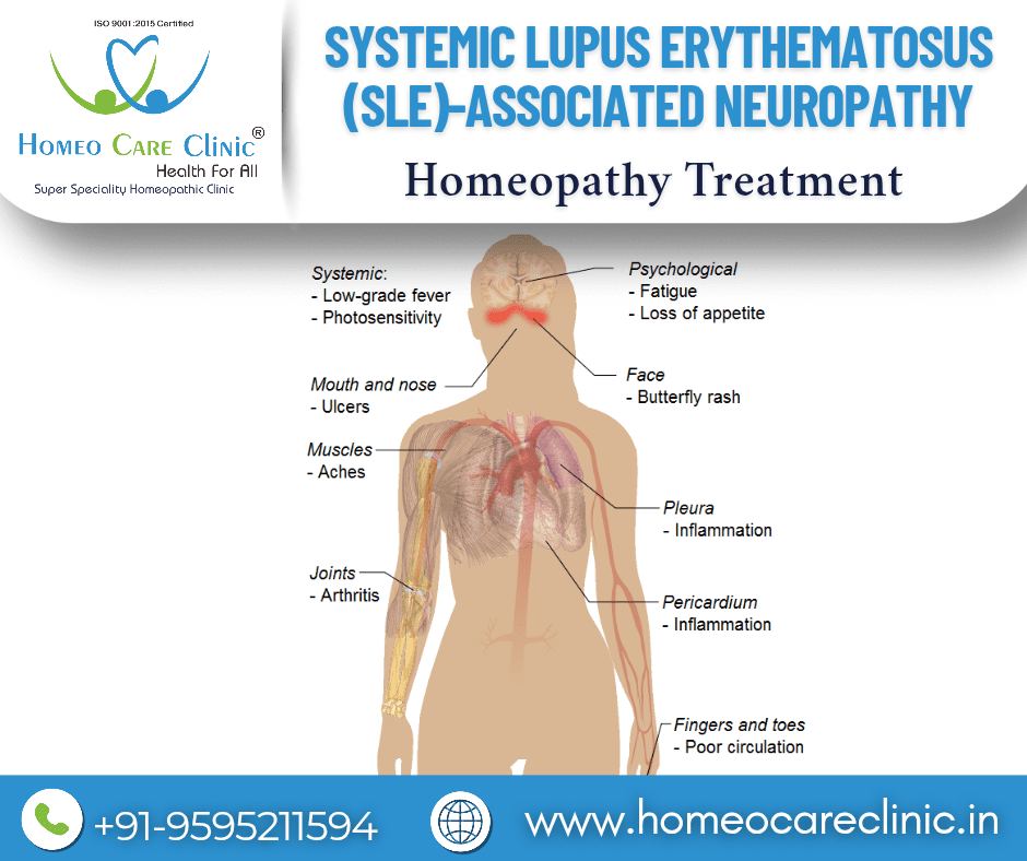 SLE-associated neuropathy symptoms