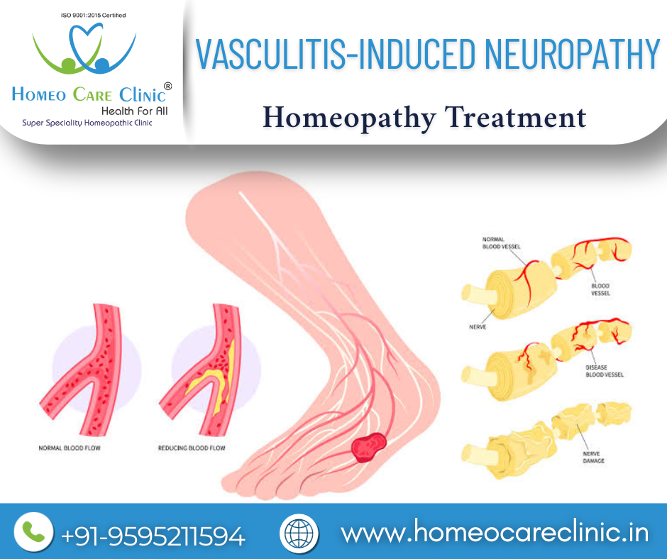 homeopathic treatment for vasculitis-induced nerve pain