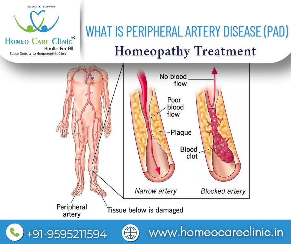 homeopathic treatment for peripheral artery disease