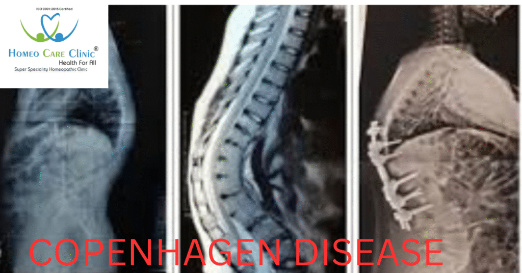 Copenhagen Disease symptoms and treatment