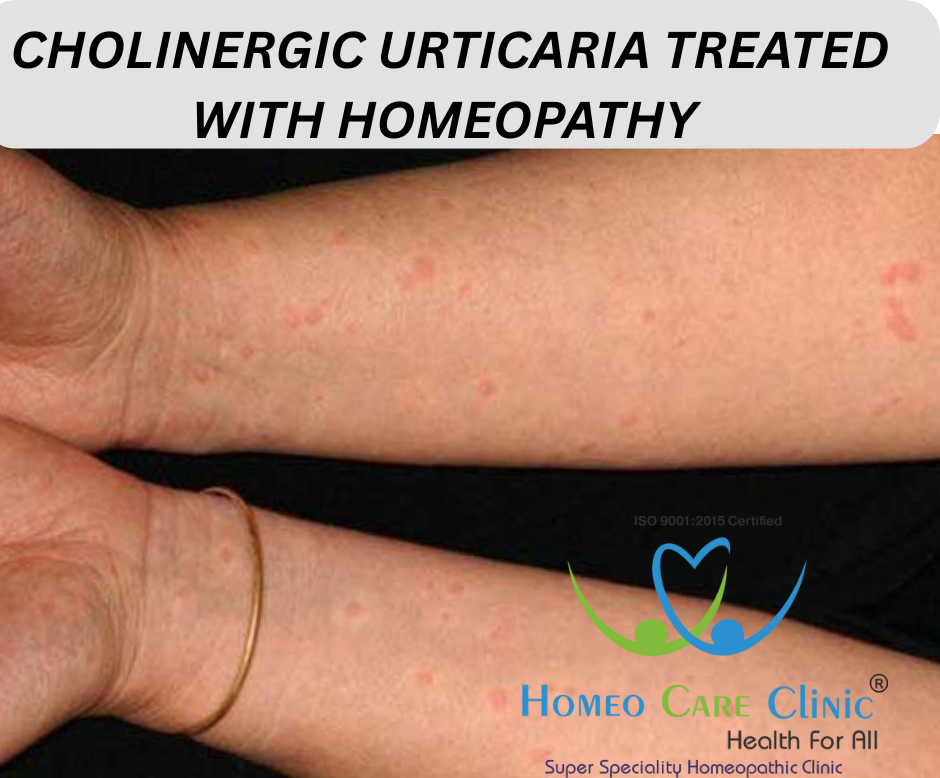 Cholinergic Urticaria