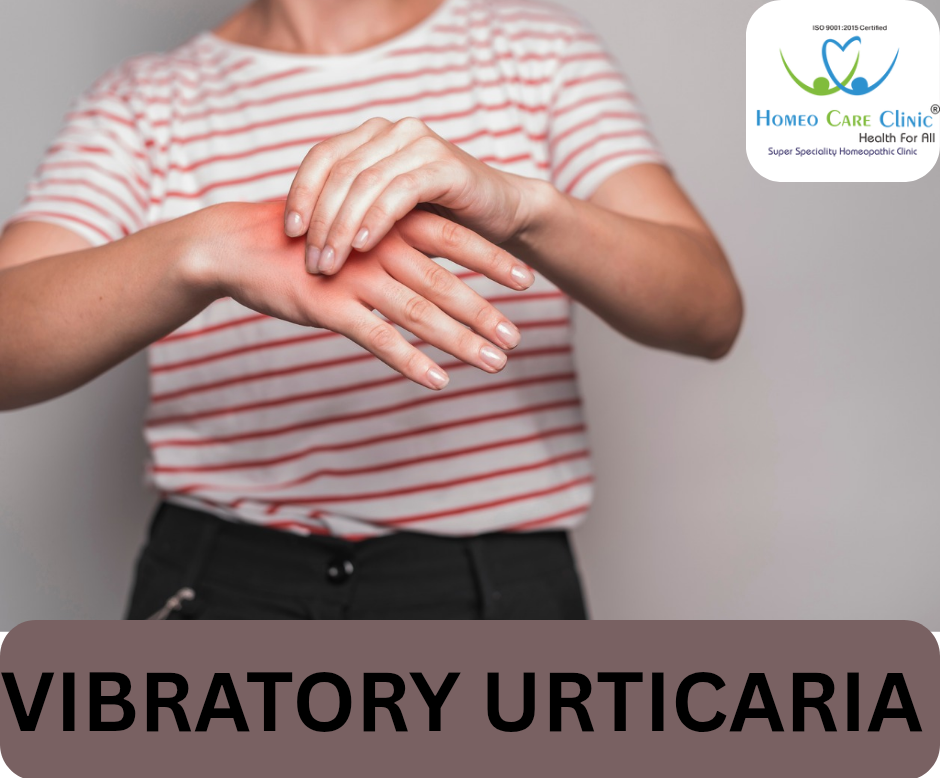 Vibratory Urticaria Treatment