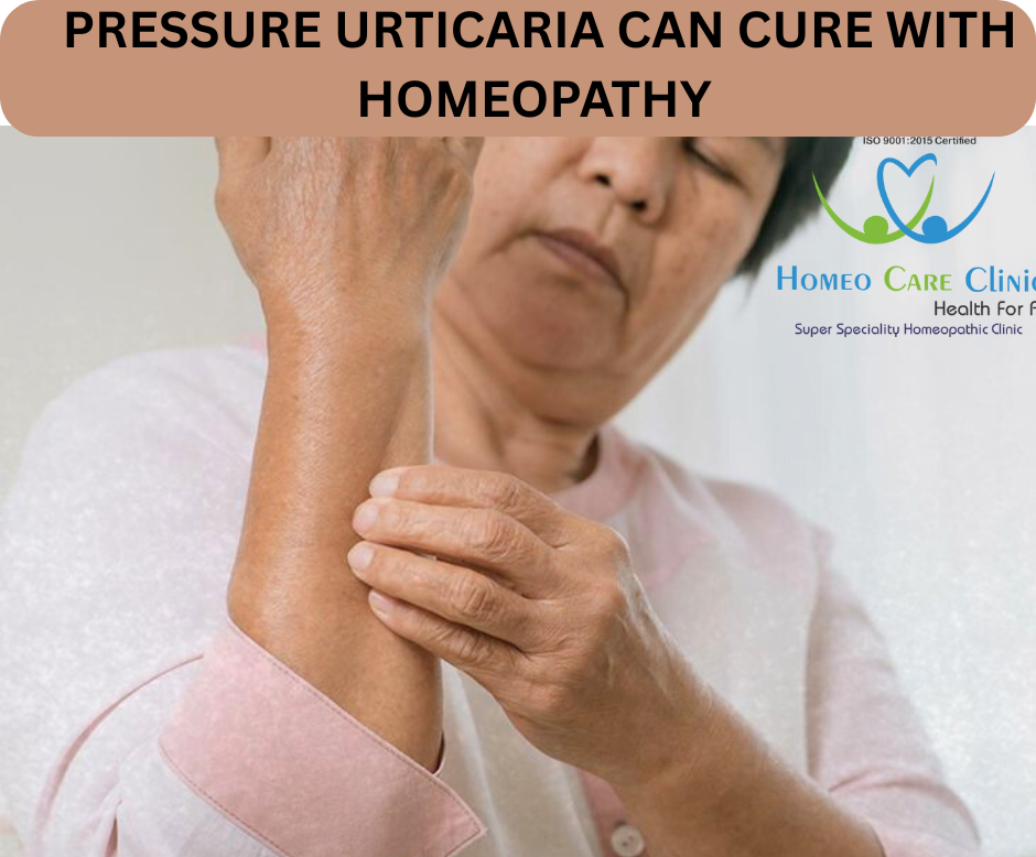 pressure urticaria
