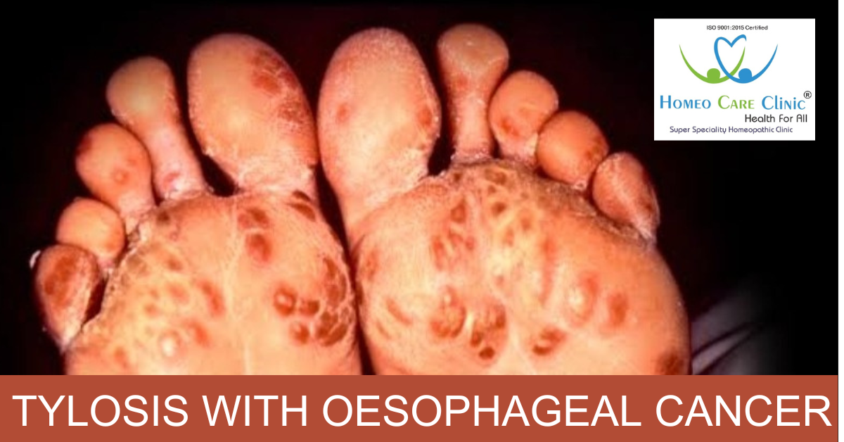 ankylosing vertebral hyperostosis tylosis symptoms homeopathy
