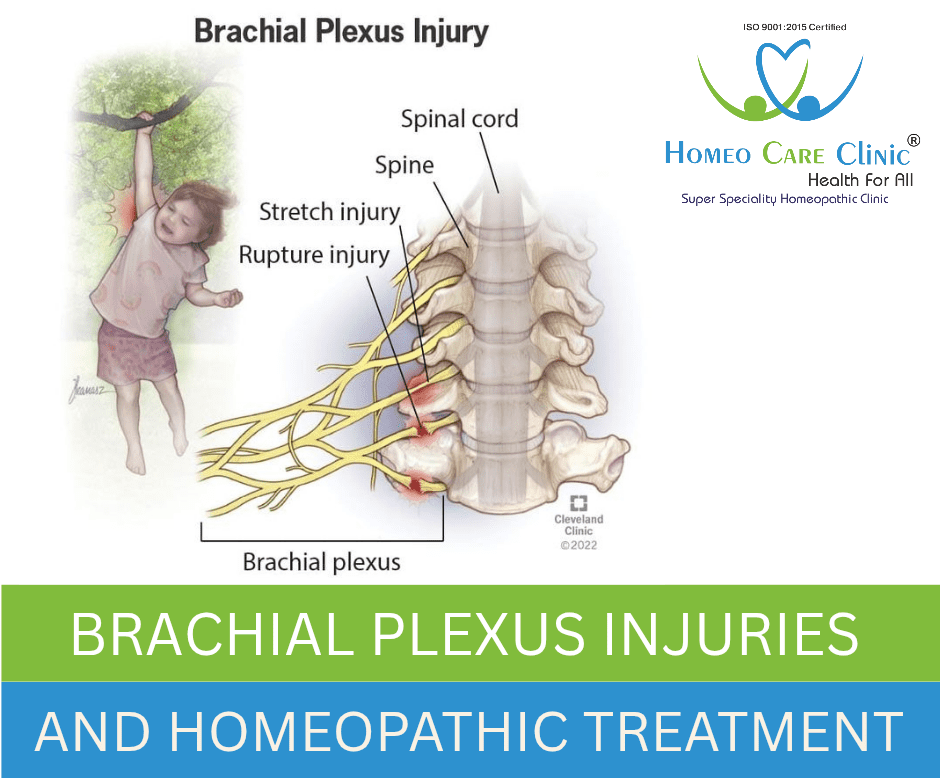Brachial Plexus Injuries and Its Causes