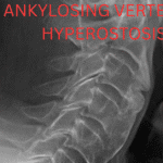 ankylosing vertebral hyperostosis tylosis symptoms homeopathy