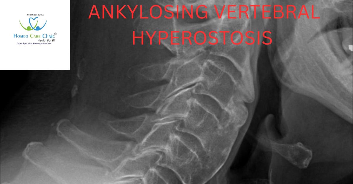 ankylosing vertebral hyperostosis tylosis symptoms homeopathy