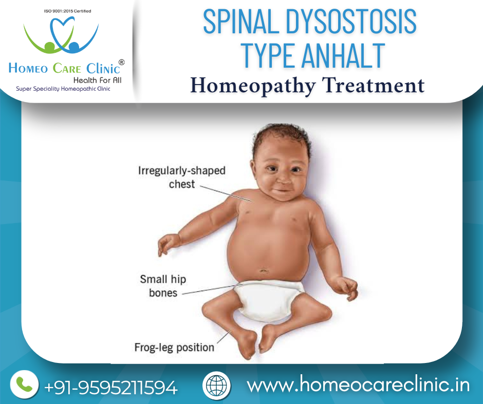 homeopathy for spinal dysostosis