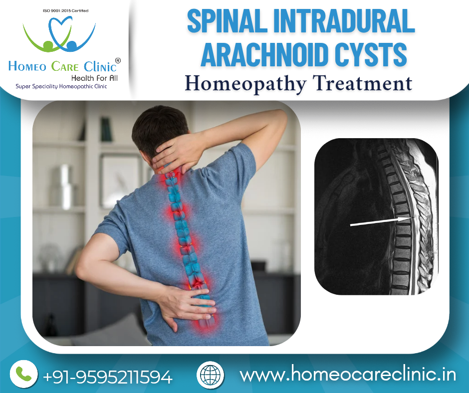 spinal intradural arachnoid cysts