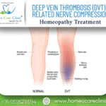 Deep Vein Thrombosis (DVT)